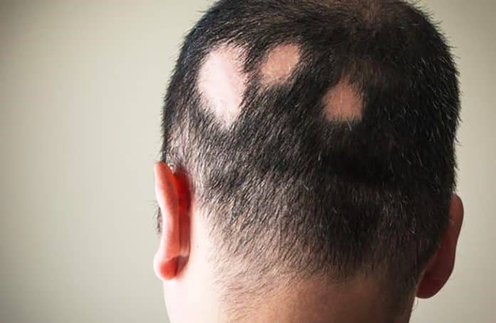 Alopecia areata adalah salah satu jenis penyakit autoimun yang menyerang folikel rambut. Kondisi ini bisa mengakibatkan terjadinya kerontokan rambut, bahkan kebotakan.