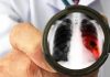 Paru-paru kotor dapat terjadi akibat paparan asap rokok, polusi udara, infeksi virus atau bakteri, bahkan paparan zat kimia. Paru-paru kotor, yang ditandai dengan adanya bercak pada organ ini, umumnya baru bisa terdeteksi ketika menjalani CT scan toraks, (Poto: Ilustrasi).